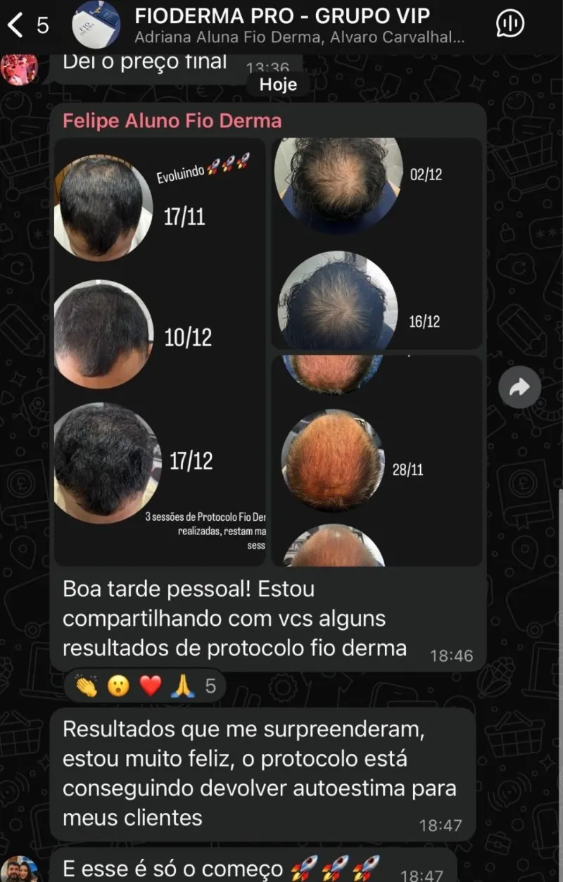 Evolução real do protocolo Fio Derma